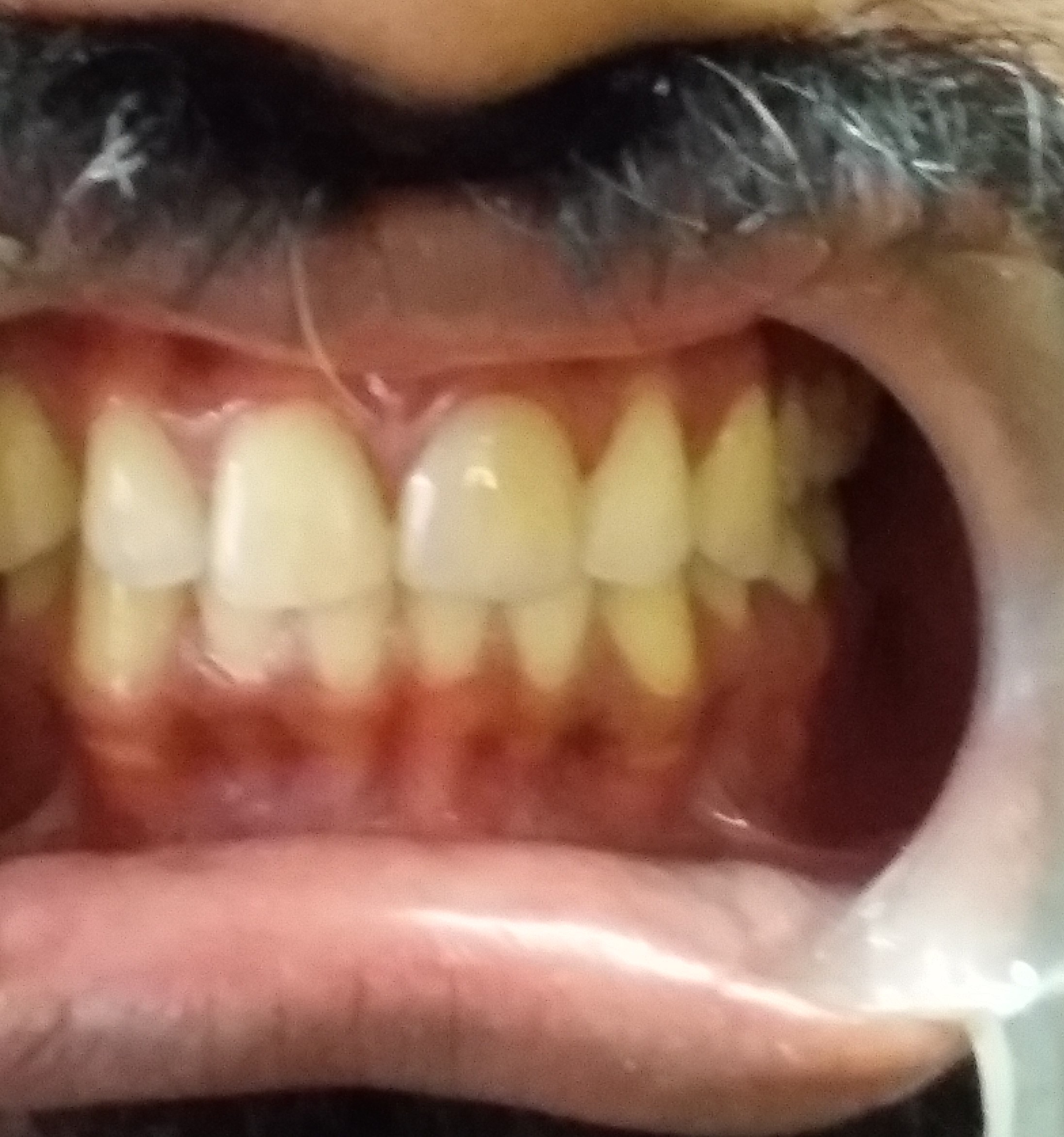 Before treatment - discoloured tooth and spacing