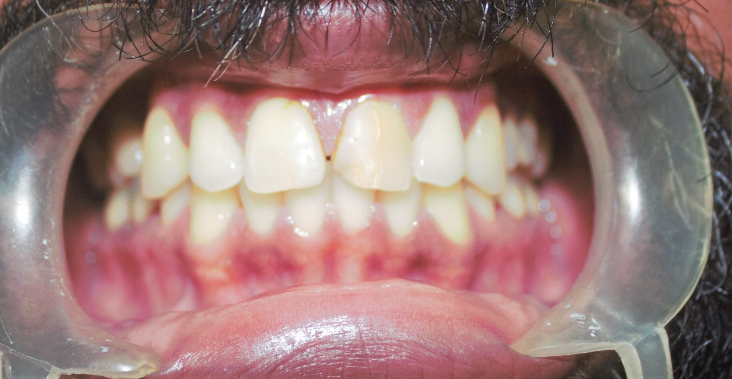 After treatment - discoloured tooth and spacing